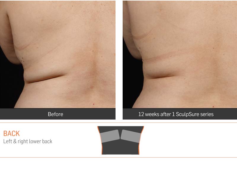 Dr Anita Sadaty SculpSure New York Before After Slide 1