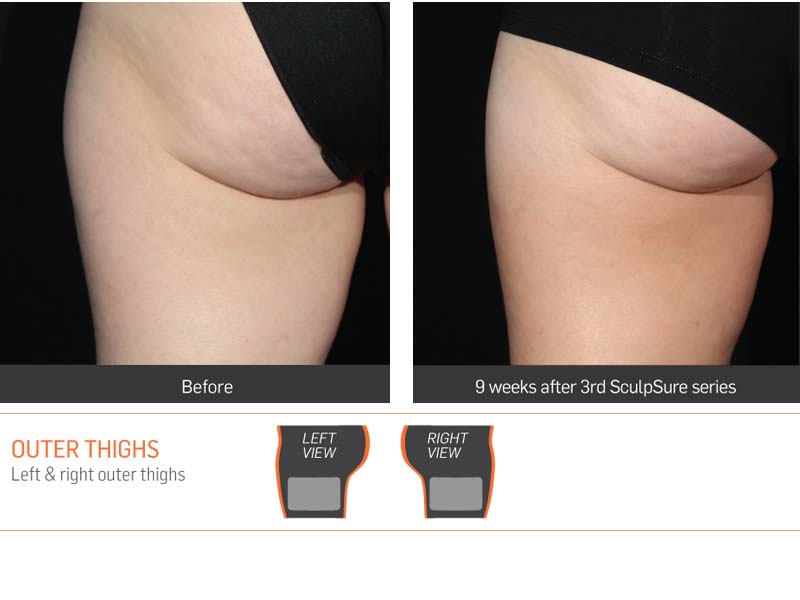 Dr Anita Sadaty SculpSure New York Before After Slide 2