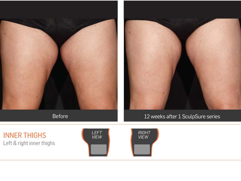 Dr Anita Sadaty SculpSure New York Before After Slide 3