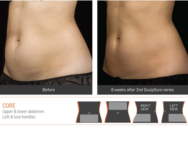 Dr Anita Sadaty SculpSure New York Before After Slide 4