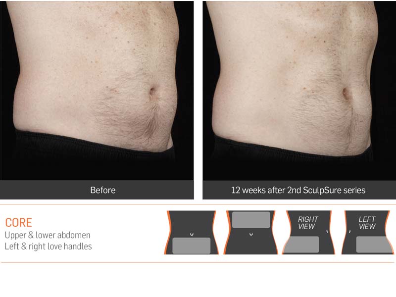 Dr Anita Sadaty SculpSure New York Before After Slide 5