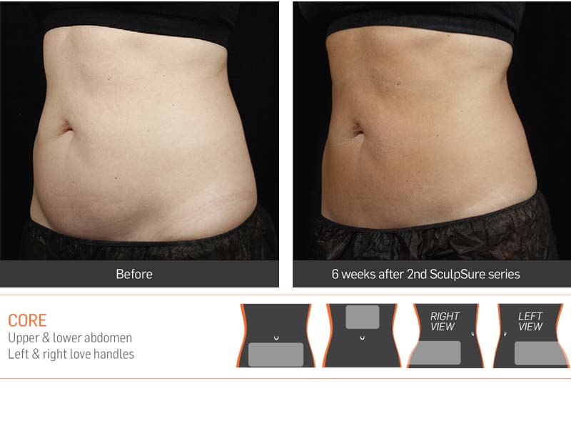 Dr Anita Sadaty SculpSure New York Before After Slide 6