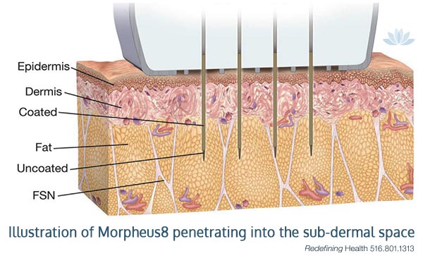 How the Morpheus8 microneedling works