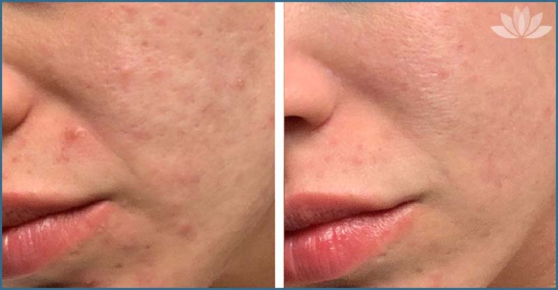 New York Morpheus Skin Treatment For Acne