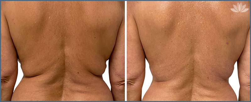 New York Morpheus Skin Treatment For Back Fat Folds