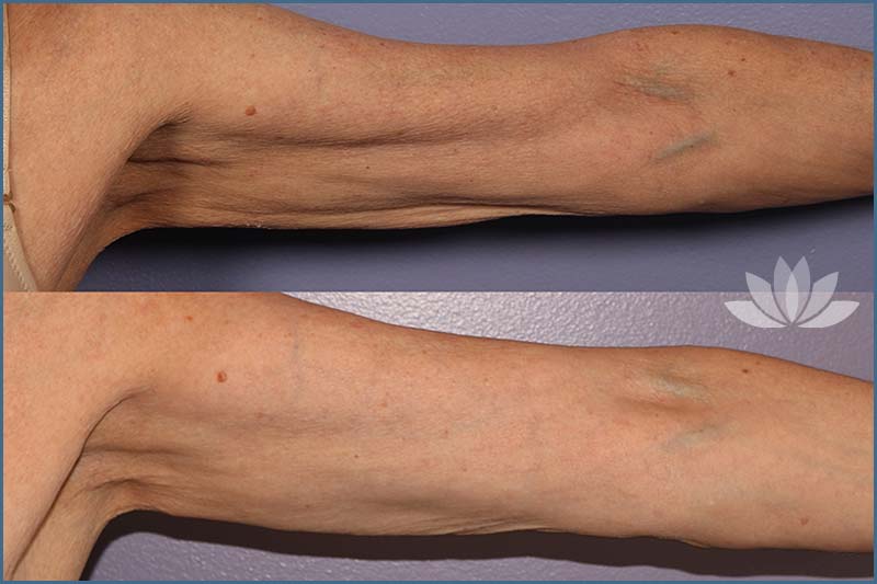 New York Morpheus Skin Treatment For Flabby Arms