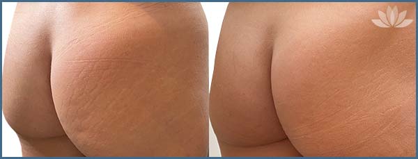 New York Morpheus8 Microneedling For The Buttocks