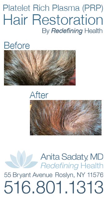 Platelet Rich Plasma (PRP) Hair Restoration New York