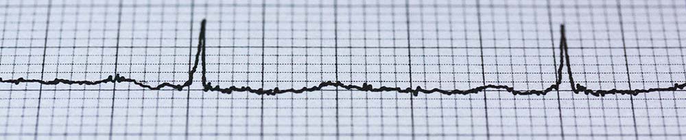 Heart Health - Cholesterol and Statins