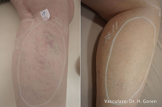 Before and After picture of Vasculaze vein treatment